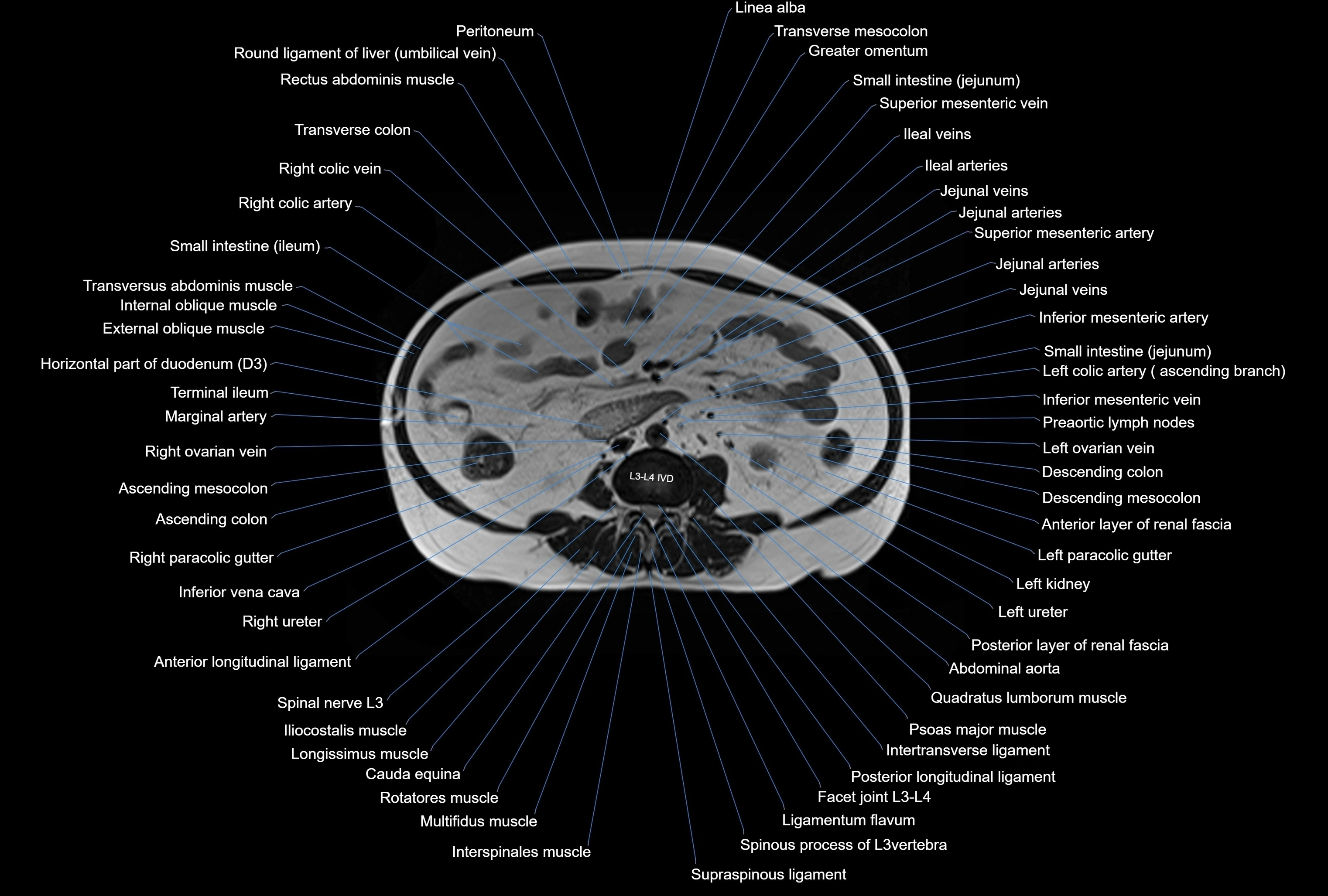 MRI Abdomen axial cross sectional anatomy radiology  image-img-00001-00028.webp
